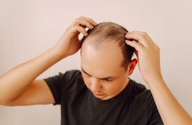 alopecia androgenética